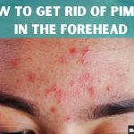 how to get rid of pimples in the forehead