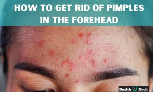 how to get rid of pimples in the forehead