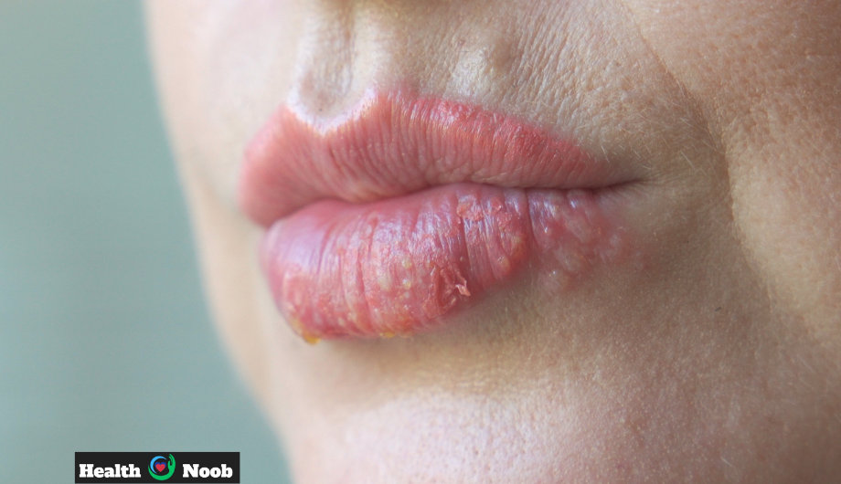 how to get rid of a pimple on your lip
