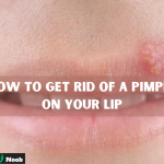 how to get rid of a pimple on your lip